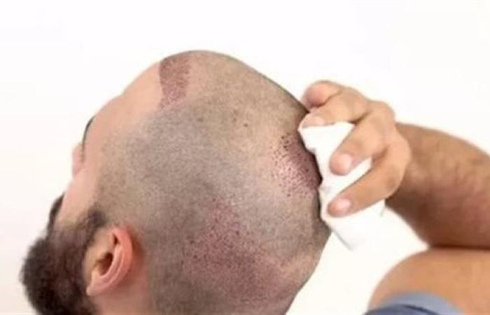 أضرار زراعة الشعر.. 5 مخاطر محتملة ولكن هل تصل إلى السرطان؟