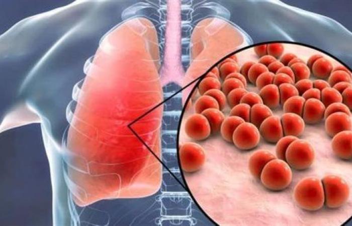 دراسة تحذر من أعراض الإصابة بـ مرض السل