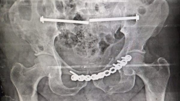 نجاح أول عملية بعد تشغيل وحدة جراحات كسور الحوض بمستشفى النيل في القليوبية